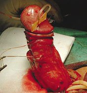 penis plastic surgery penis plastic surgery