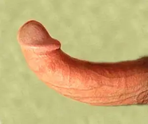 Can you fix a bent penis? One that is bending from Peyronies disease? Yes! You can do it easily and safely if