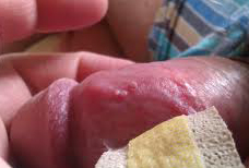 228px x 154px - HPV Symptoms: What Are They? and Can They Cause a Bent Penis?