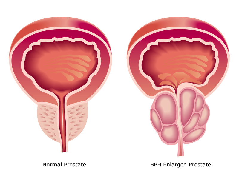 BPH - Benign Prostatic Hyperplasia