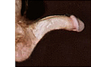 vaginismus from a bent penis