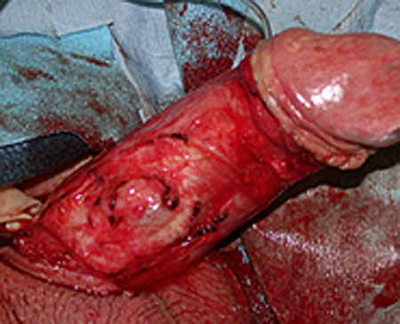fix a broken penis with degloving
