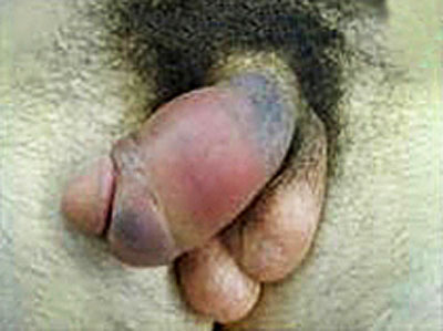 broken penis, fractured penis, tunica albuginea