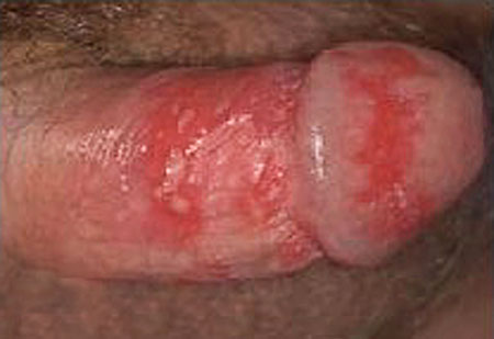 penis genital herpes, herpies