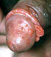 there is no cure for the hpv genital wart
