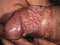 genital wart problem