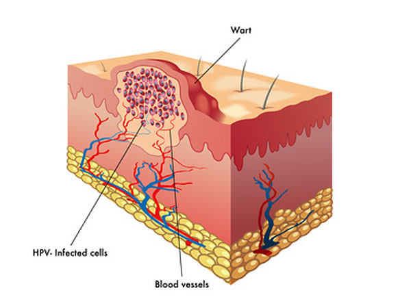 hpv warts diagram