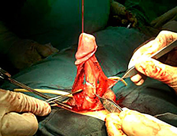 degloving penis surgery