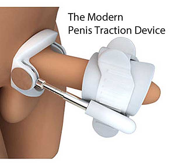 Is penis traction effective for straightening a bent penis caused by Peyronies Disease?