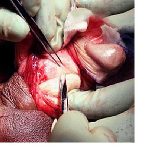 Peyronies Disease penis surgery.