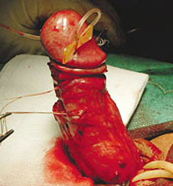 phalloplasty, penis surgery to straighten a bent penis