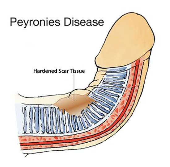 the cause of Peyronies disease curvature