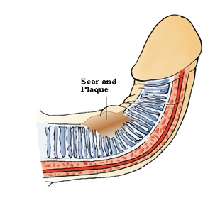 what causes peyronies disease is simple scar and/or plaque deposits inside your penis