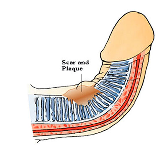 reverse erectile dysfunction, a bent penis caused by peyronies disease