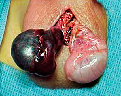 testicular torsion is a medical emergency