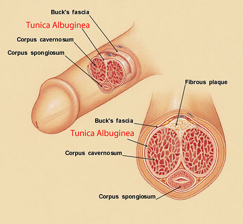 tunica albuginea and a bent penis caused by peyronies disease