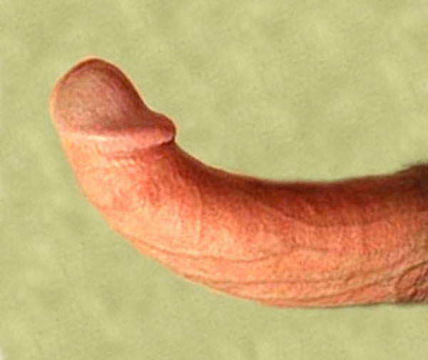 A Bent Penis caused by Peyronies Disease.