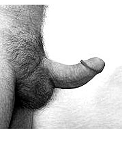 erectile dysfunction pills are not for a bent penis