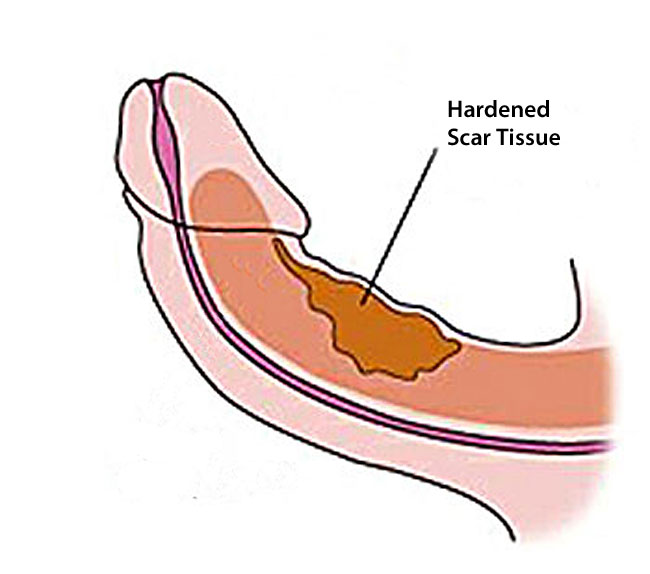 what causes a curved penis?