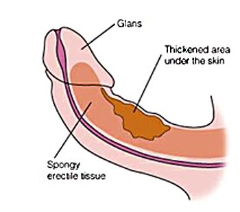 dyspareunia and peyronies disease