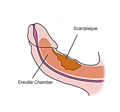 why you can straighten a bent penis caused by peyronies disease