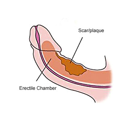 there is no peyronies disease cure