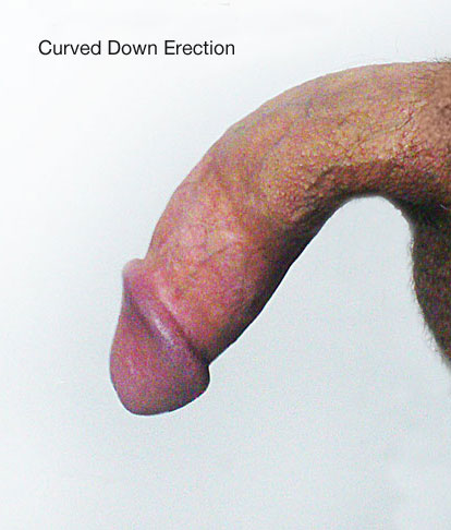 curved down penis