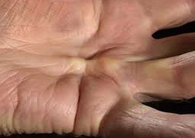 How to fix Dupuytrens Contracture, by yourself