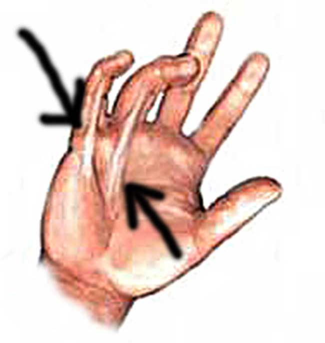 Dupuytrens Contracture has a simple fix