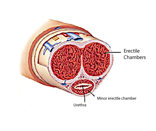 erectile chambers and peyronies disease