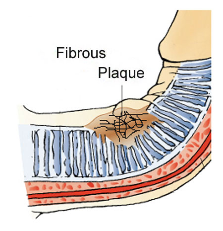 fibrous plaque