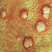HPV genital warts