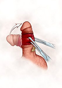 nesbit procedure