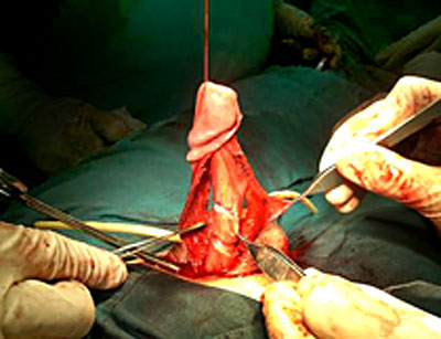 Peyronies disease and penis straightening surgery