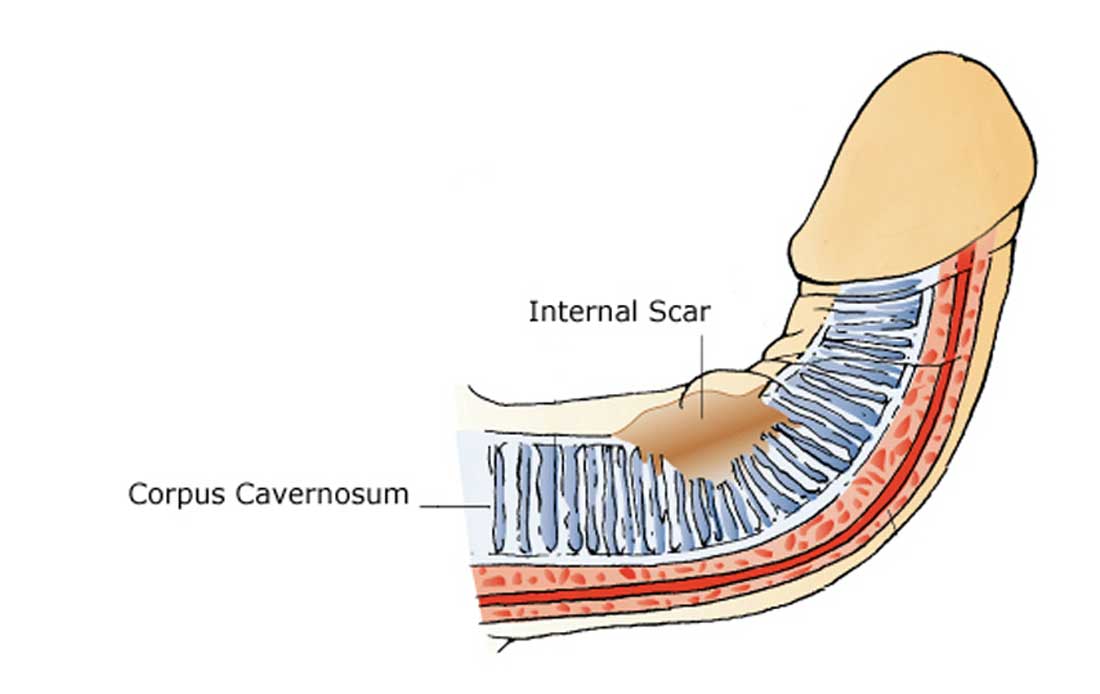 Dupuytrens Contracture and a bent penis