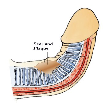 bent penis disease scar and plaque diagram