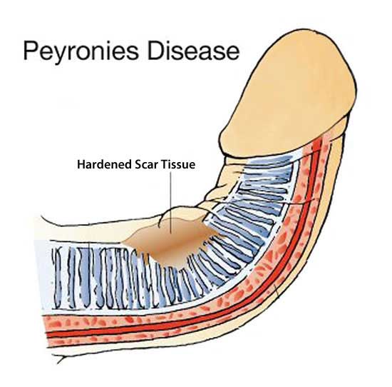 Can a broken penis cause bending?