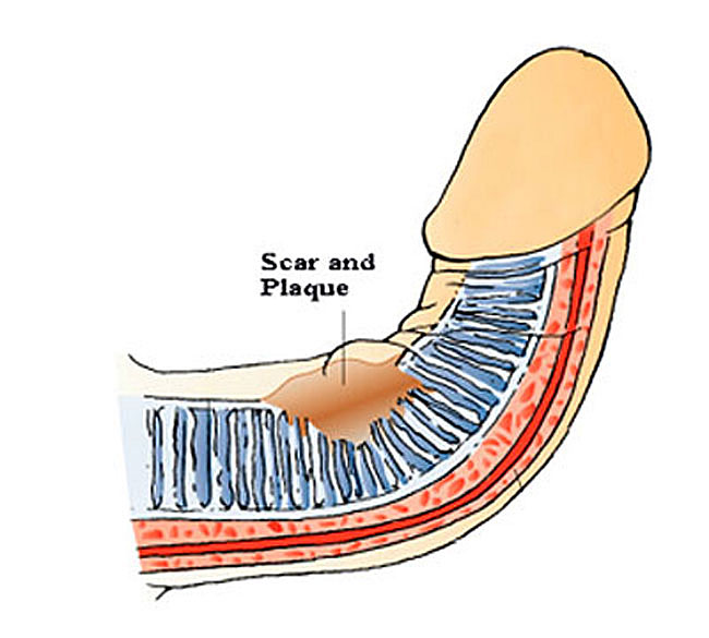 peyronies disease stages