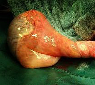 testicular torsion picture