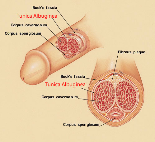 bent penis can cause erectile dysfunction